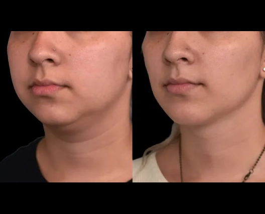 Laser double chin removal in Dubai—Top providers