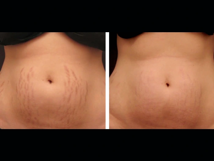 Flawless Complexion with Radiofrequency (RF) Microneedling Best Doctors in Dubai