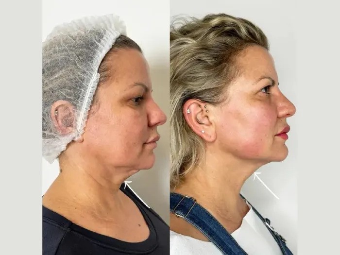Endolift for Jawline Contouring by Best Doctors in Dubai