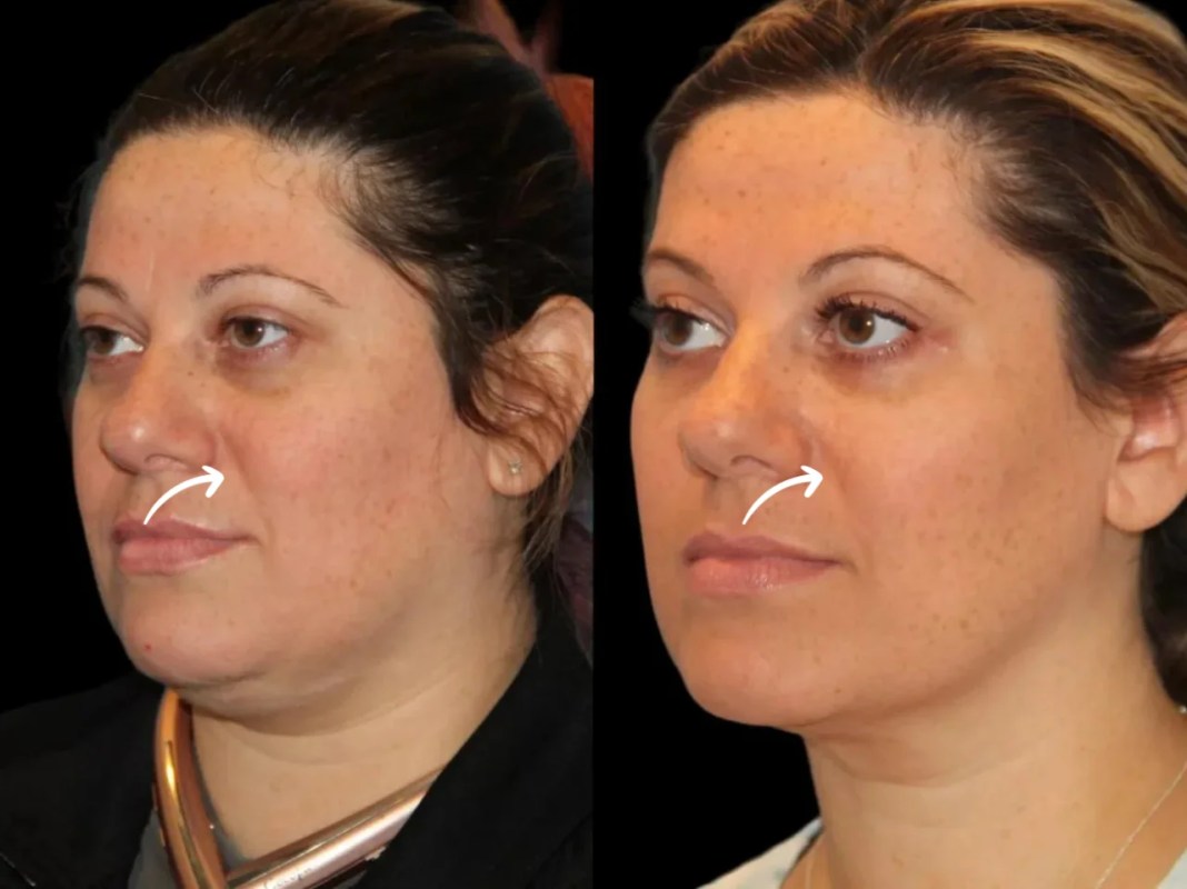Best Doctors in Dubai for Repeat Sculptra Fillers Sessions