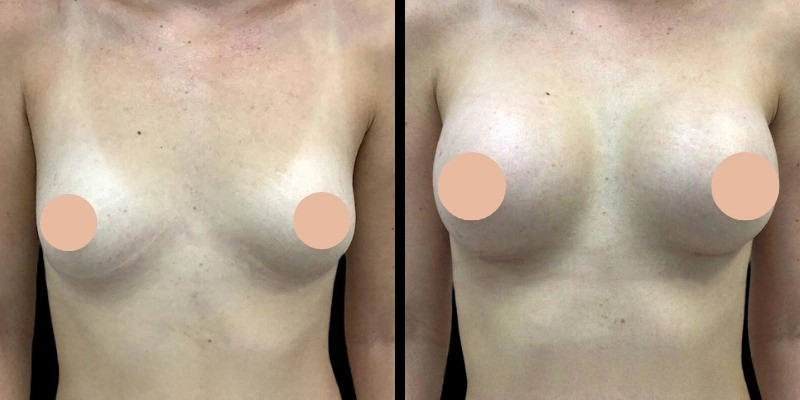 Implant Placement Options Discussed by the Best Breast Enhancement Surgeon in dubai